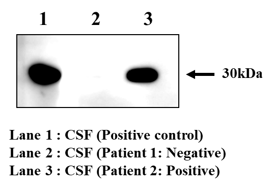 환자의 뇌척수액에서 14-3-3 단백질의 웨스턴-블럿 분석 결과